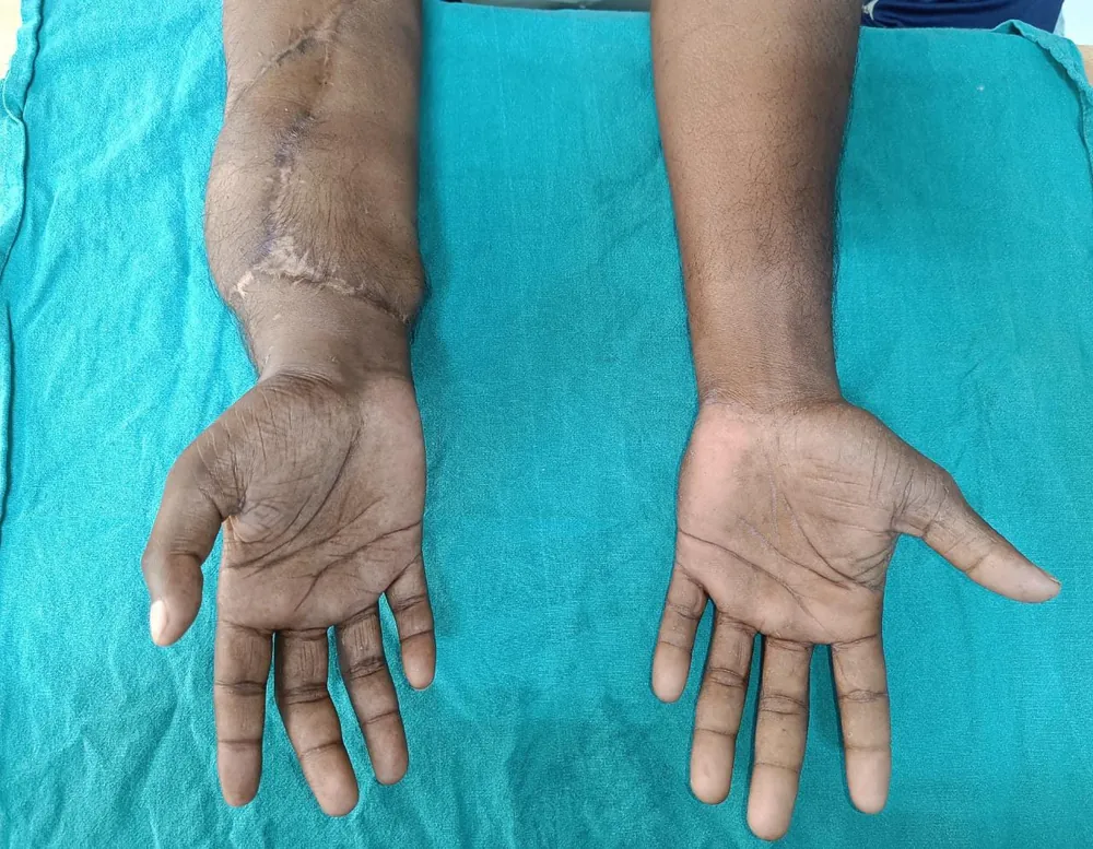 Nine months after surgery, alongside the uninjured hand.