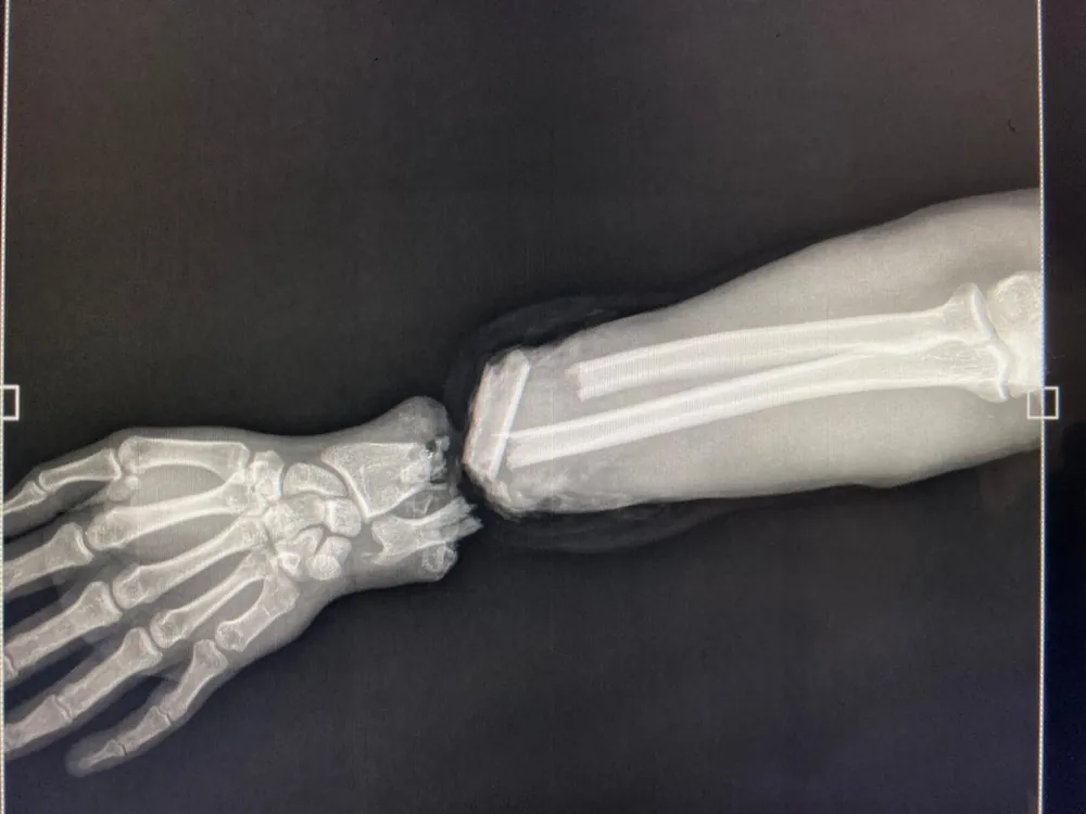 Radiograph on arrival — the hand is completely separated at the wrist.