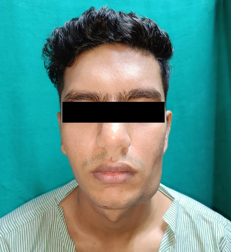 Before surgery — fullness of the lower jaw distorting facial symmetry.